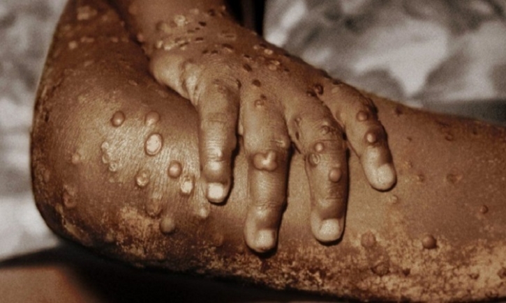 WHO to work closely with countries responding to monkeypox